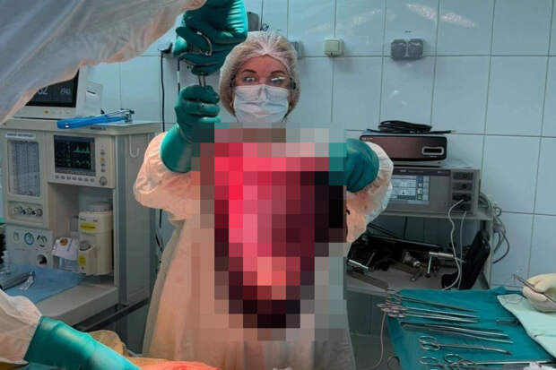 В Красноярске врачи удалили 31-летней женщине гигантскую опухоль яичников