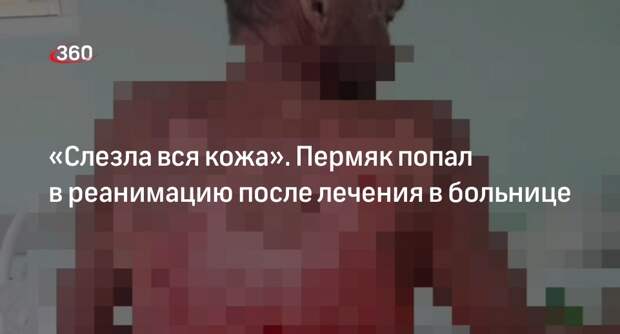 Мужчина остался без кожи на на лице и теле после лечения в больнице в Перми
