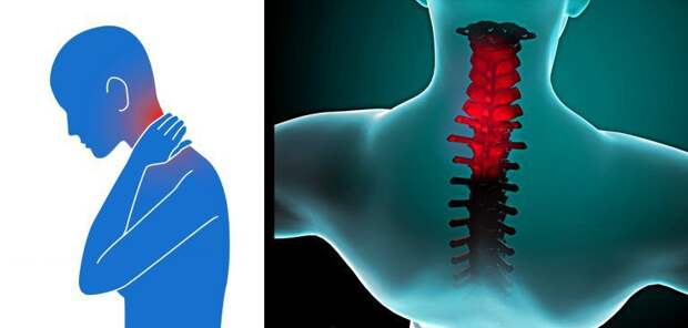 Лечение шейного остеохондроза: отзывы, методы, препараты и народные рецепты