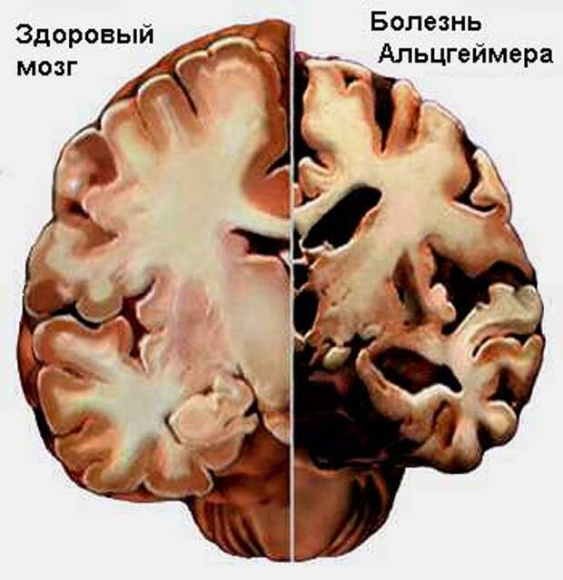 Картинки по запросу альцгеймер