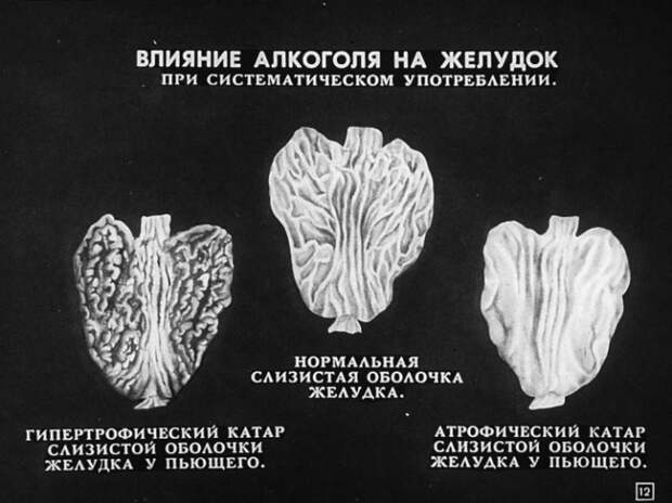 Алкоголизм и борьба с ним. Диафильм