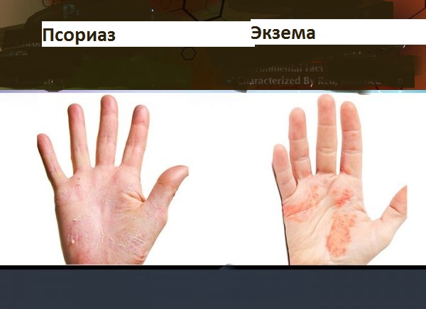 Чем отличается псориаз от экземы: основные различия, причины и методы лечения