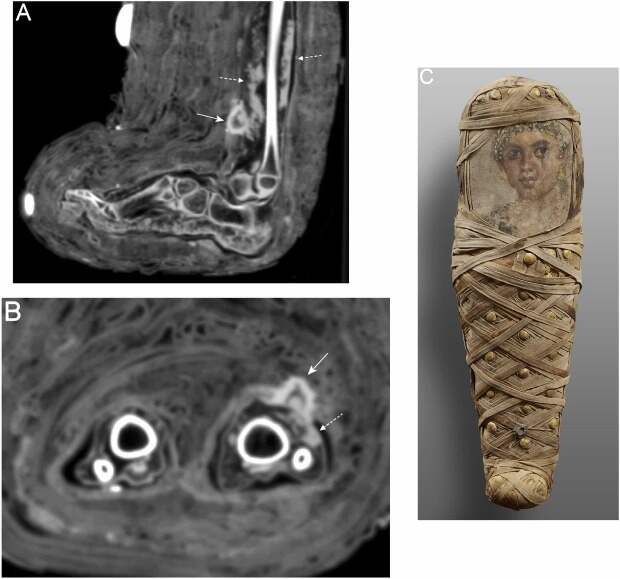 Палеопатологи обнаружили следы гнойных инфекций в древнеегипетских детских мумиях