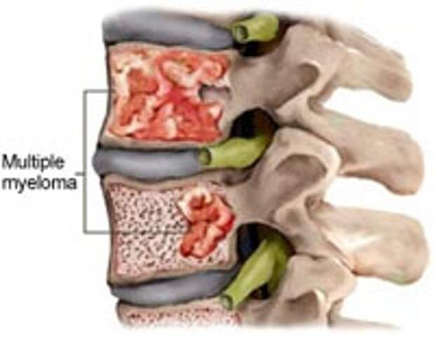 Рак костного мозга симптомы. Миеломная болезнь позвоночника. Злокачественные заболевания костного мозга. Неоплазия костного мозга.