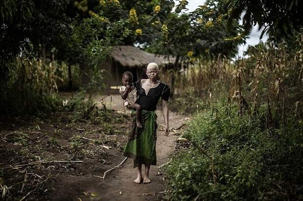 Жуткая реальность: в Африке людей-альбиносов убивают, чтобы сделать из них амулеты