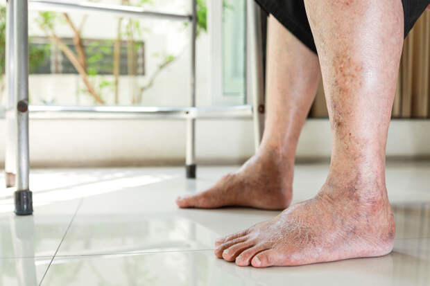 Врач Купряшов: поза "нога на ногу" пережимает сосуды и ведет к тромбам