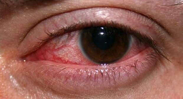 Красные глаза – причины и лечение у взрослого