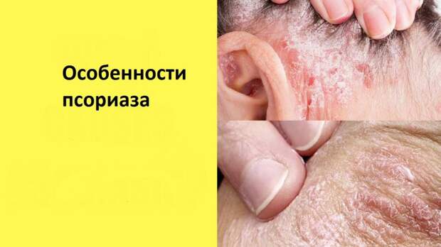 Чем отличается псориаз от экземы: основные различия, причины и методы лечения