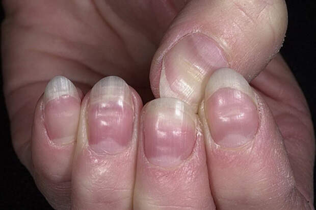 Что состояние ваших ногтей говорит о вашем здоровье