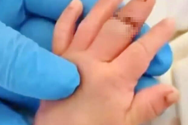 SCMP: акушерка в Китае случайно отрезала палец новорожденному