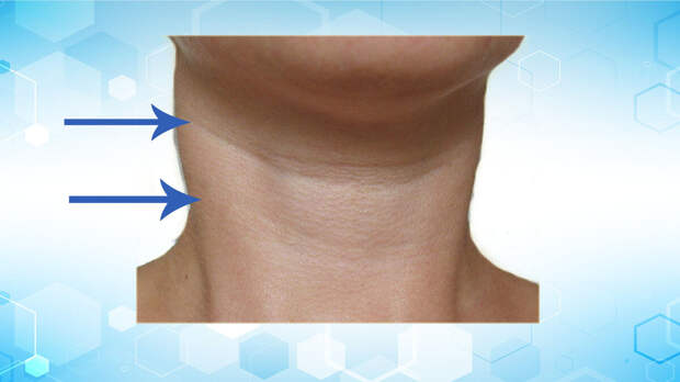 Пример морщин на юной шее: так называемые "Кольца венеры".  