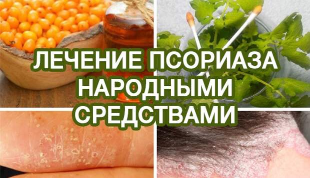 лечение-псориаза-народными-средствами