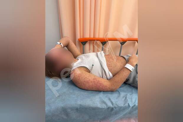 Московская школьница чуть не умерла в Новый год от редкого синдрома, при котором «закипает» кожа