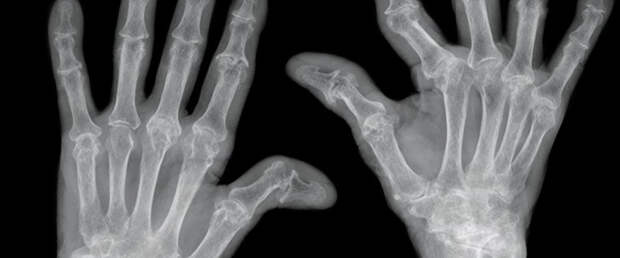 Новая технология выявляет артрит за 10 минут