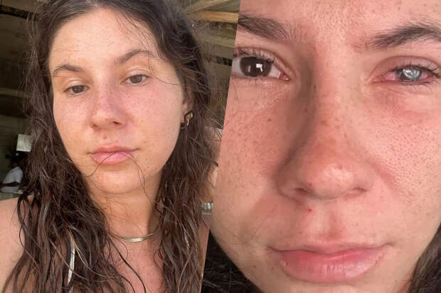 People: девушка рискует потерять зрение из-за паразита, поедающего роговицу