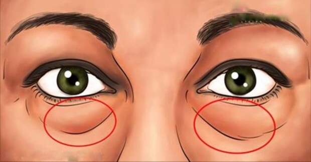 Изучите лучшие естественные методы удаления темных кругов и мешков под глазами. Супер экспресс-средства!