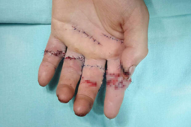 В Москве врачи спасли пальцы мужчине, рука которого попала в подъемный механизм