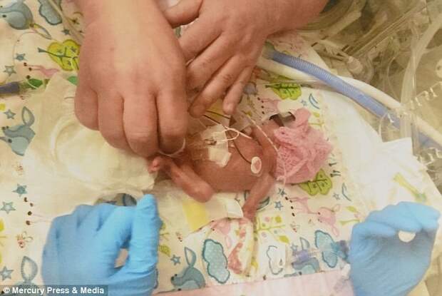 Крошечная девочка выжила, несмотря на неблагоприятные прогнозы  медиков ребенок родился до срока, чудо