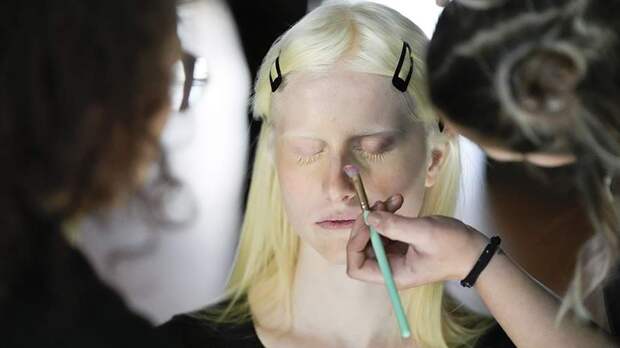 Дерматолог рассказала об опасности альбинизма