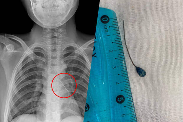 Московские врачи извлекли булавку из бронха 11-летнего мальчика