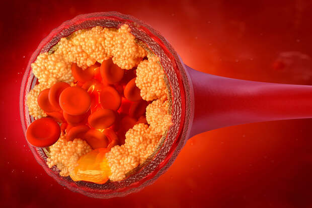 NEJM: препарат энлицитид снижает "плохой" холестерин на 60%