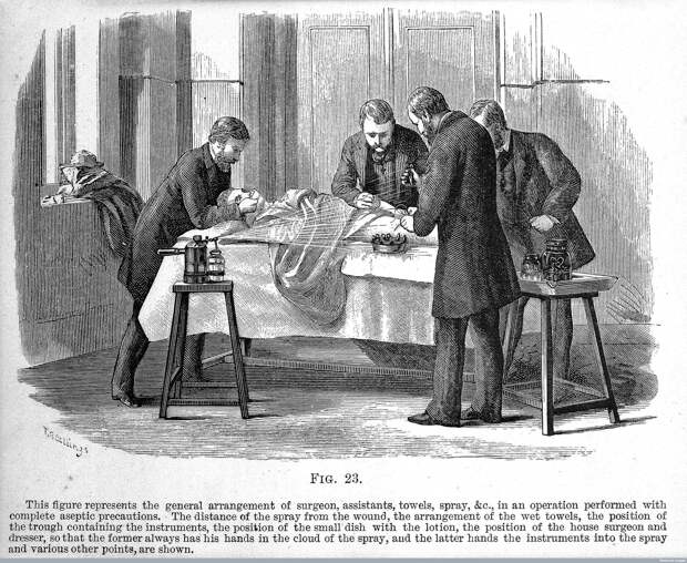 Use of the Lister carbolic spray, Antiseptic surgery, 1882.