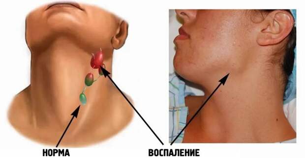 Гиперпластический синдром: симптомы, диагностика, лечение
