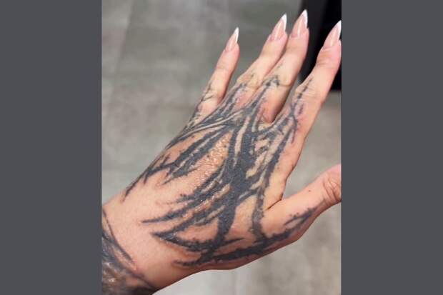 Решившая удалить татуировки россиянка показала шрамы по всему телу после процедуры
