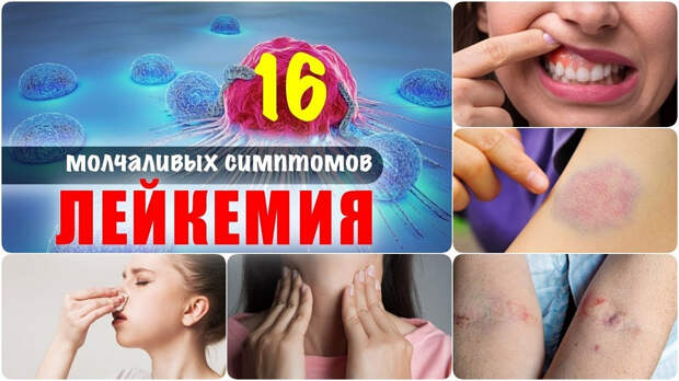 Лейкемия и 16 молчаливых симптомов рака крови, которые нельзя пропустить