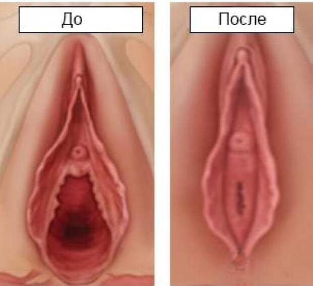 Нитевой лифтинг промежности форум. Подтяжка влагалища нитями