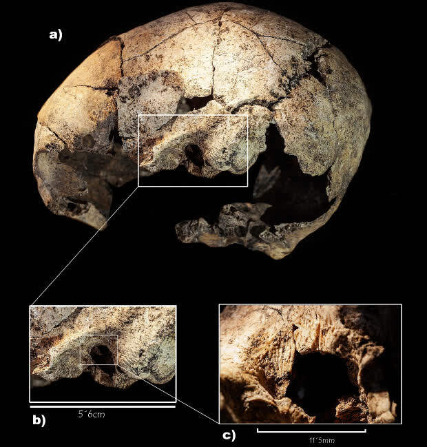 Палеопатологи обнаружили древнейшие свидетельства мастоидотомии