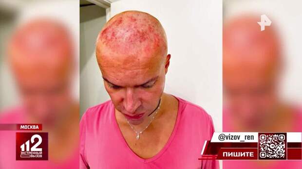 Гоген Солнцев получил 1,5 миллиона рублей компенсации за сожженные волосы