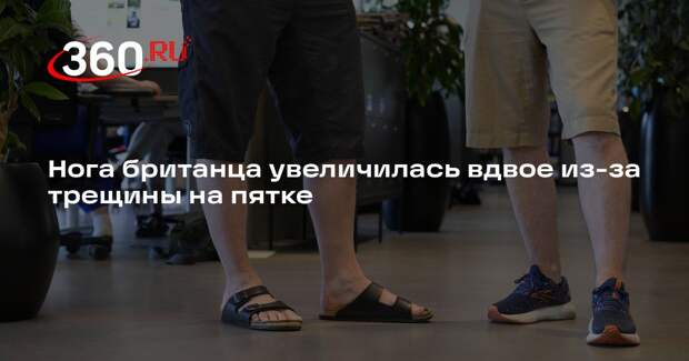 Нога британца увеличилась вдвое из-за трещины на пятке
