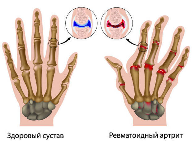 Первые симптомы ревматоидного артрита пальцев рук