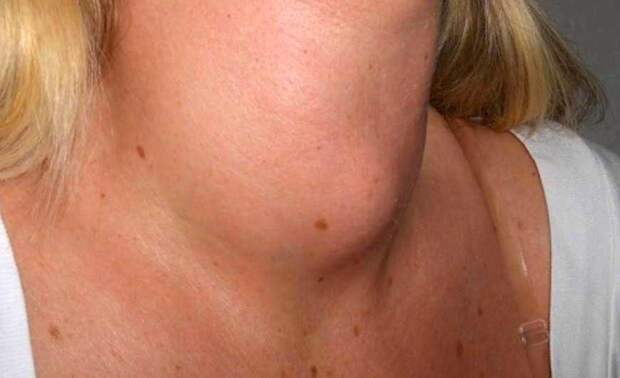 Узлы в щитовидке: что скрывается под термином «узел», как распознать заболевания и лечить. Йододефицит и его последствия