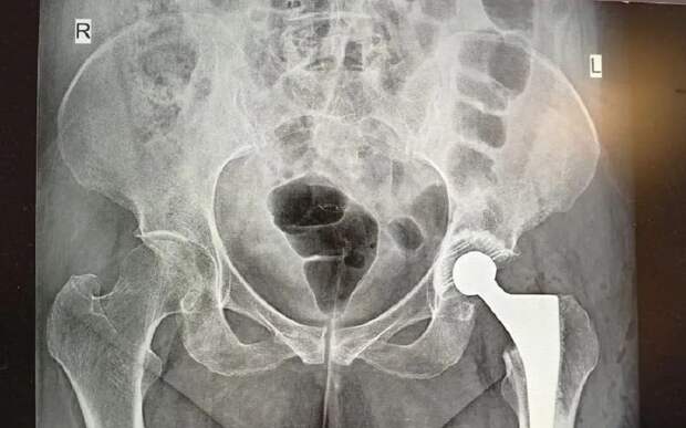 Рязанские хирурги спасли 95-летнюю бабушку от инвалидности