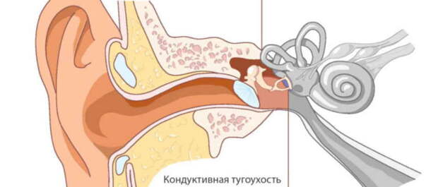 Через три недели женщина начала слышать и уже давно забыла о том, что когда-то глухотой страдала