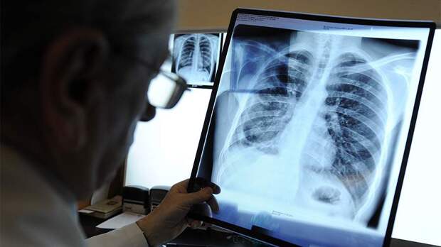 Врач рассказала об отличающих туберкулез от обычного кашля ранних симптомах