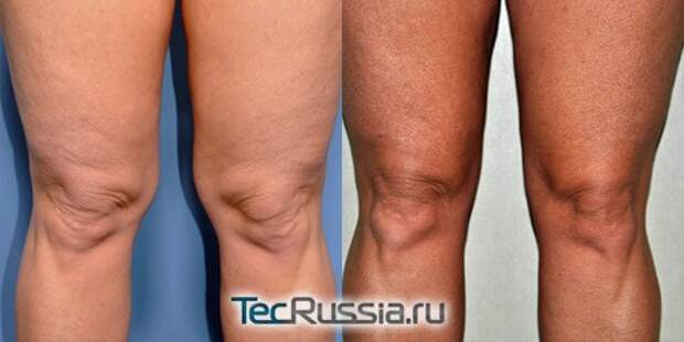 1371495232_knee_fat_1