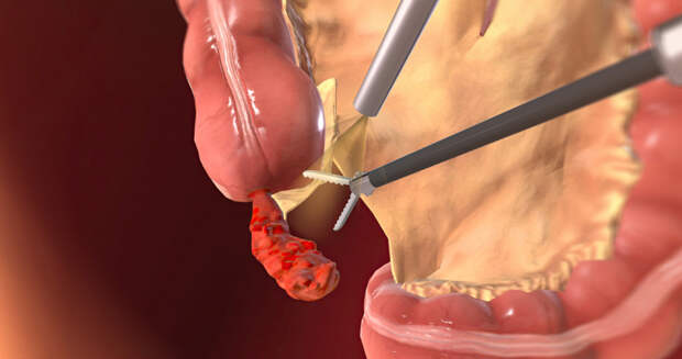 Хронический аппендицит: Тихая угроза в правом боку, которую многие игнорируют