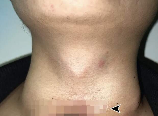 The Sun: шея британца начала гнить из-за некроза, вызванного татуировкой