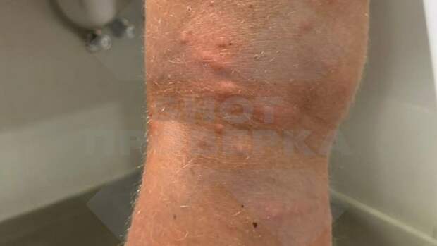 Адский зуд и волдыри от укусов. Песчаные мухи кошмарят россиян на Сейшелах