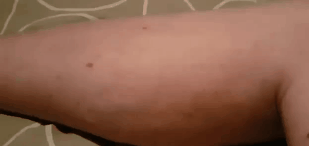 Мышечный спазм Мышечный спазм